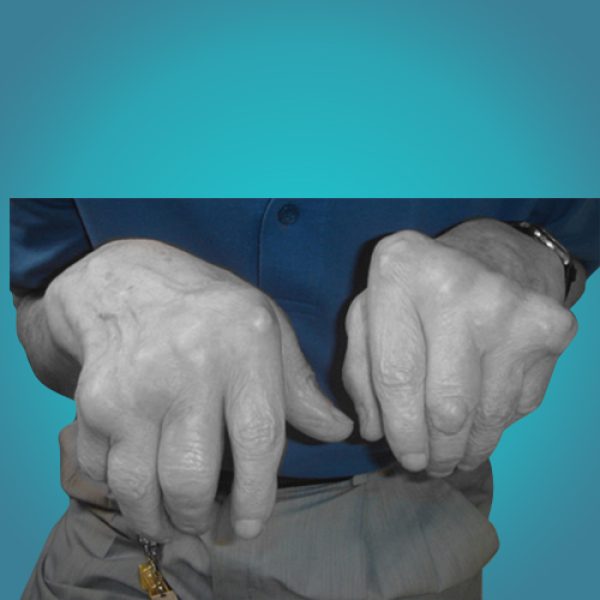 arthritis arthritis